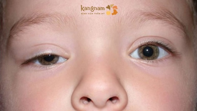 Rối loạn cơ nâng mi phổ biến nhất gây nên tình trạng sụp mí bẩm sinh