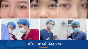 Sụp mí bẩm sinh là gì? Nguyên nhân, dấu hiệu và khi nào cần điều trị