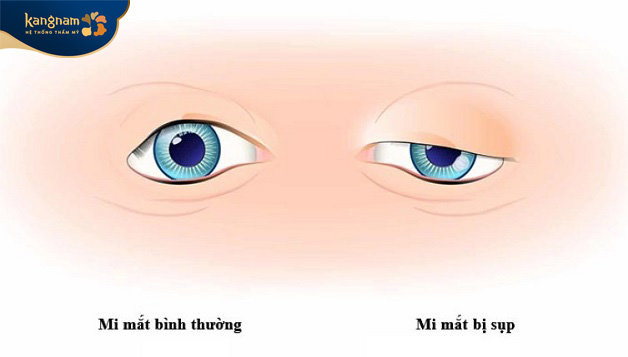 Minh họa tình trạng sụp mí mắt bẩm sinh