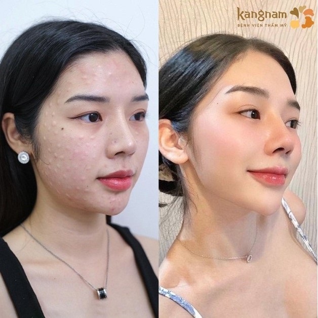 Tiêm meso để cải thiện nếp nhăn, làm da căng bóng, tươi trẻ