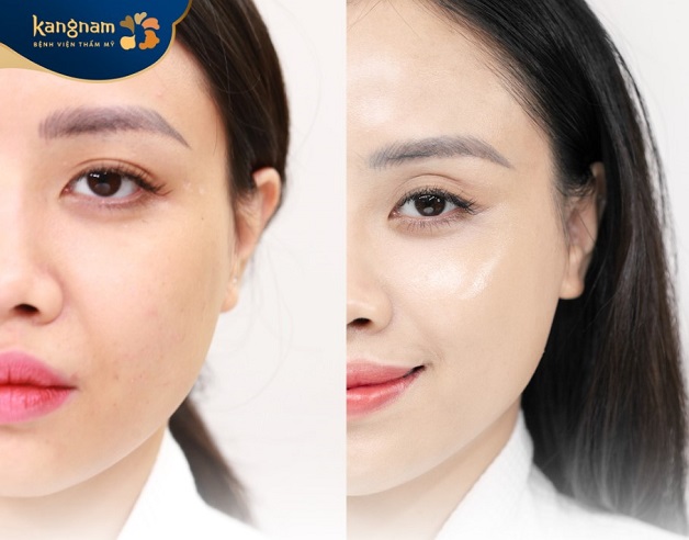 Công nghệ Hifu mang đến hiệu quả tái tạo làn da