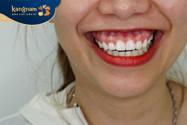 hiện tượng cười bị hở lợi không phải bệnh lý