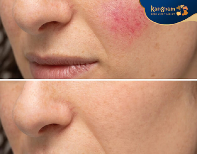 Giãn mao mạch ảnh hưởng thẩm mỹ gương mặt