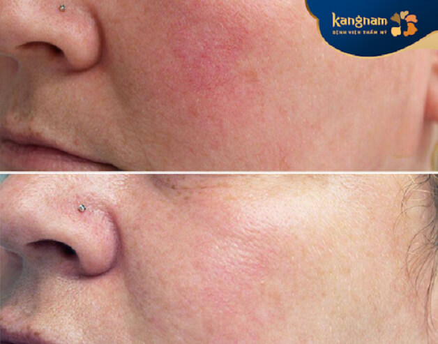 Hình ảnh thay đổi của khách hàng sau 1 lần điều trị giãn mao mạch bằng DermaV