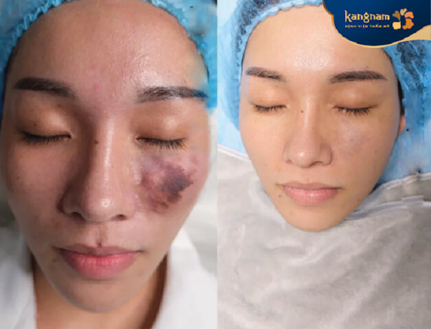 Vết bầm tím được cải thiện rõ rệt sau khi điều trị bằng DermaV