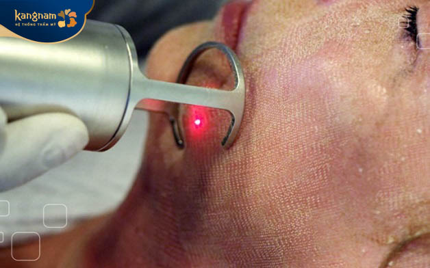 Phương pháp Laser Fractional là giải pháp hiệu quả để làm đầy sẹo lõm