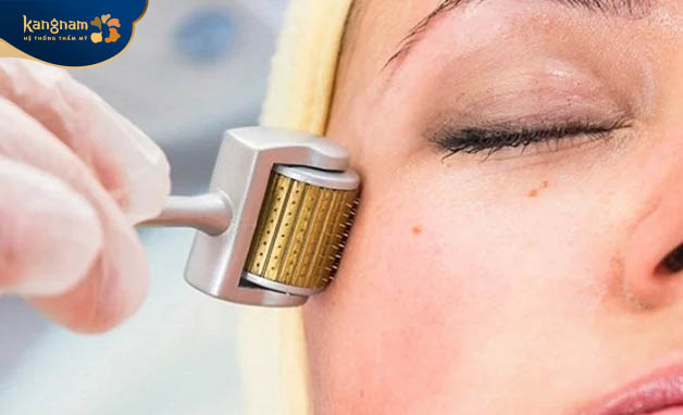 Phương pháp lăn kim điều trị sẹo là một trong những hình thức trị sẹo độc đáo và hiệu quả