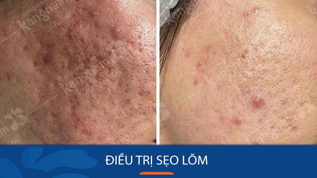 Các phương pháp điều trị sẹo lõm an toàn và những lưu ý quan trọng