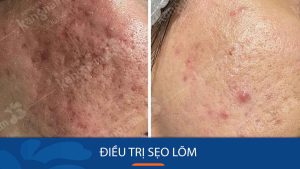 Các phương pháp điều trị sẹo lõm an toàn và những lưu ý quan trọng