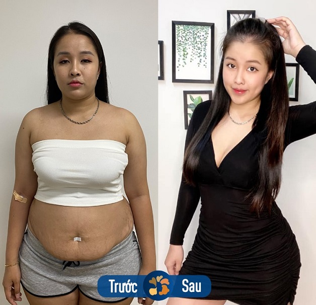 Tự tin với đường cong hoàn hảo sau hút mỡ