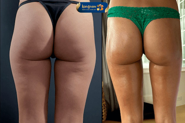 Giảm mỡ vùng mông, đùi giúp cơ thể săn chắc hơn