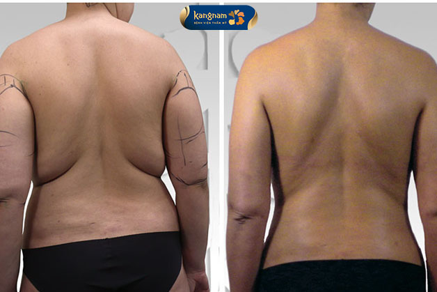 Loại bỏ mỡ thừa, có ngay vùng lưng thon gọn và mềm mại