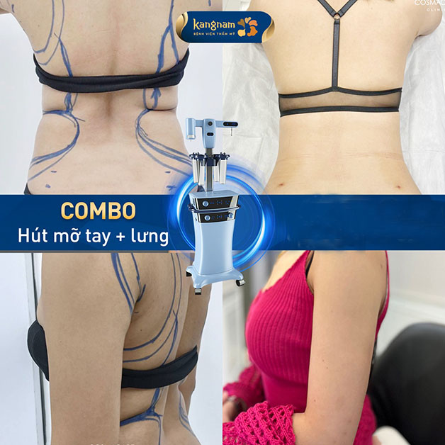 Combo giảm mỡ tay và lưng tại Kangnam, cơ thể dẻo dai và linh hoạt hơn