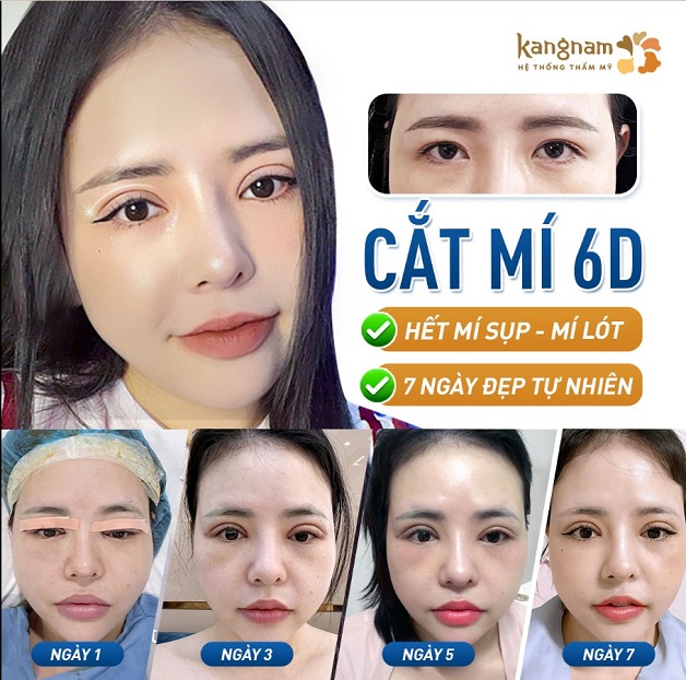 Cắt mí 6D là dịch vụ thẩm mỹ mắt được khách hàng ưa chuộng