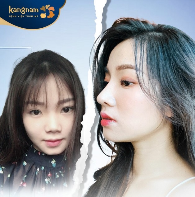 Dịch vụ thẩm mỹ mũi đa dạng, khắc phục mọi khuyết điểm trên mũi