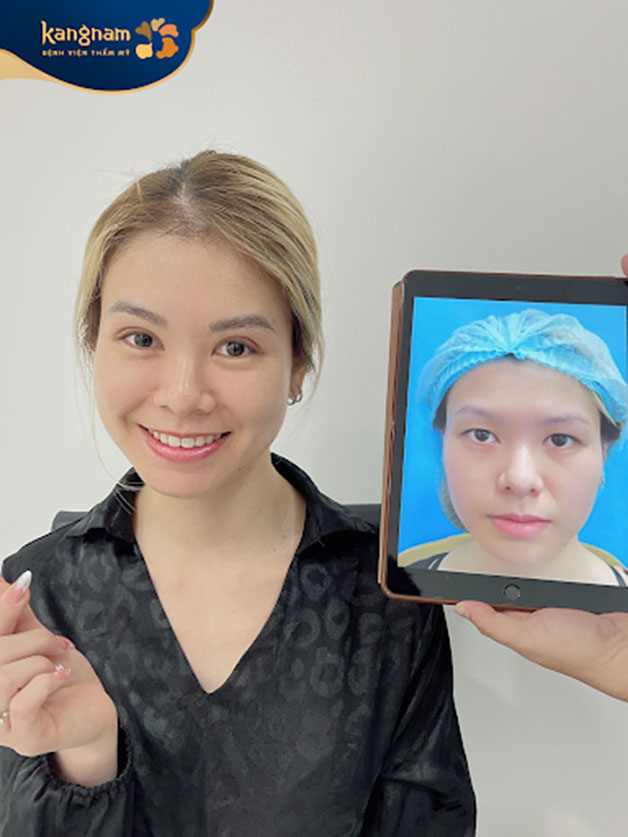 Người muốn có nếp mí rõ ràng hơn, tạo đôi mắt to tròn tự nhiên