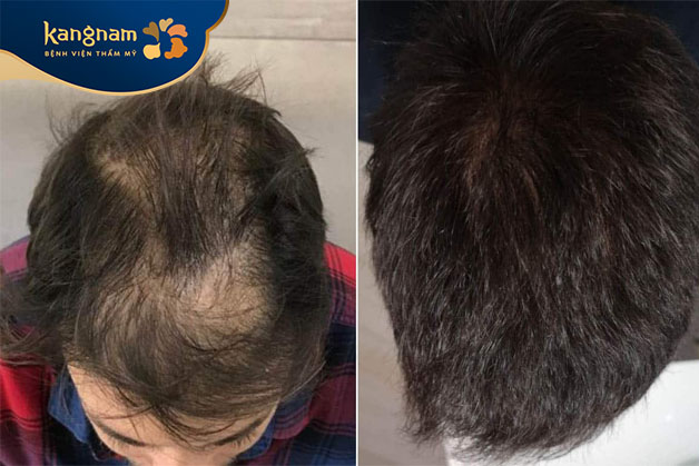 Lấp đầy vùng tóc thưa hiệu quả
