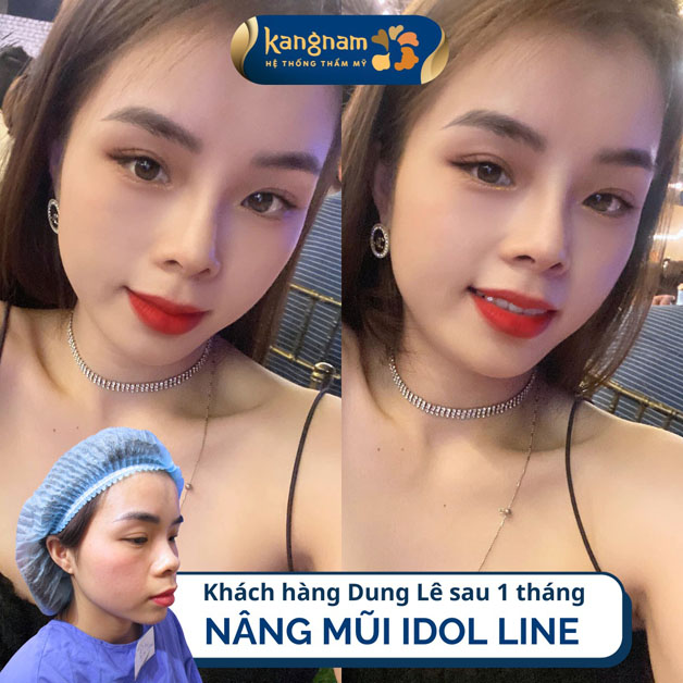 Nâng mũi chuẩn Idol Hàn Quốc