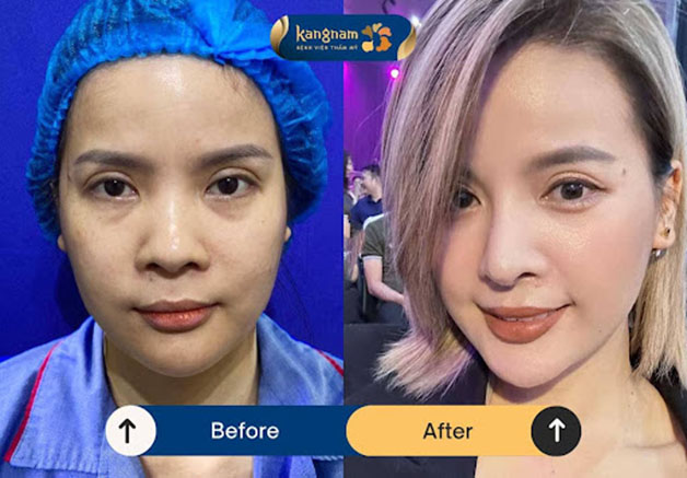 Khách hàng thu gọn đầu mũi kết hợp nâng mũi