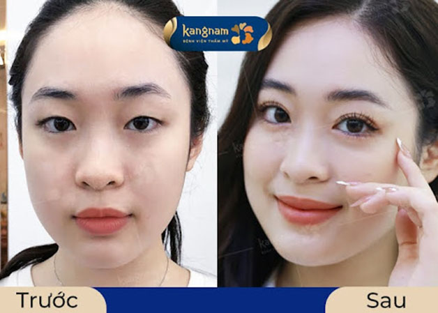 Cắt mí sau 15 ngày đã ổn định dần