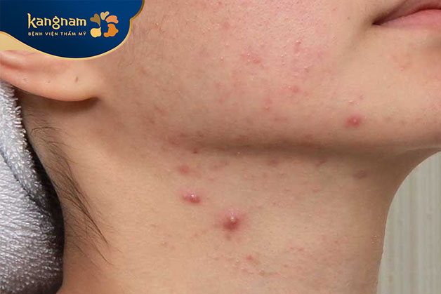 Kích ứng da khiến mụn bọc xuất hiện ở cổ
