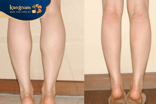 Đôi chân thon gọn rõ rệt sau giảm mỡ