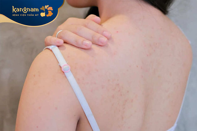 Không nên bóp, cạy mụn lưng