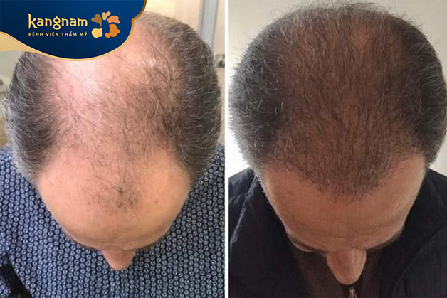 Hạn chế di chuyển ra ngoài, nhất là những nơi nhiều bụi bẩn