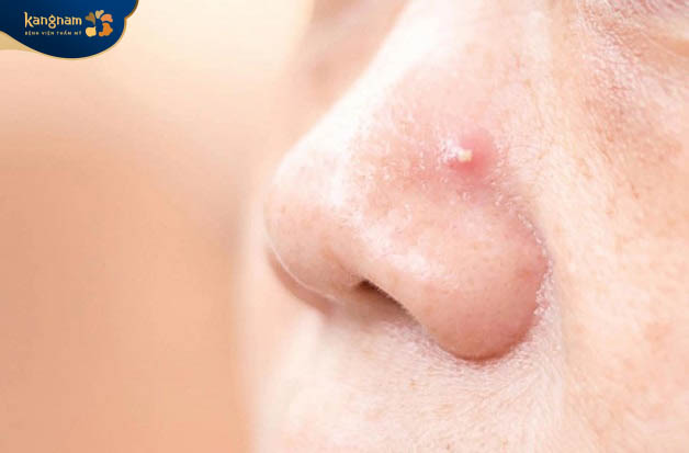 Mụn trứng cá ở mũi hình thành do lỗ chân lông bị bít tắc