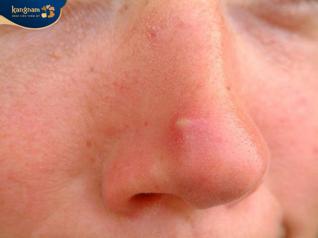 Mụn trứng cá có mủ bên trong chứa mủ trắng