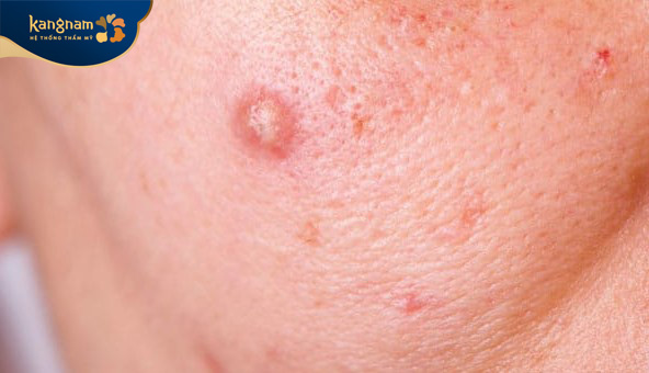 Mụn bọc ở má có kích thước lớn, sưng đỏ và gây đau nhức