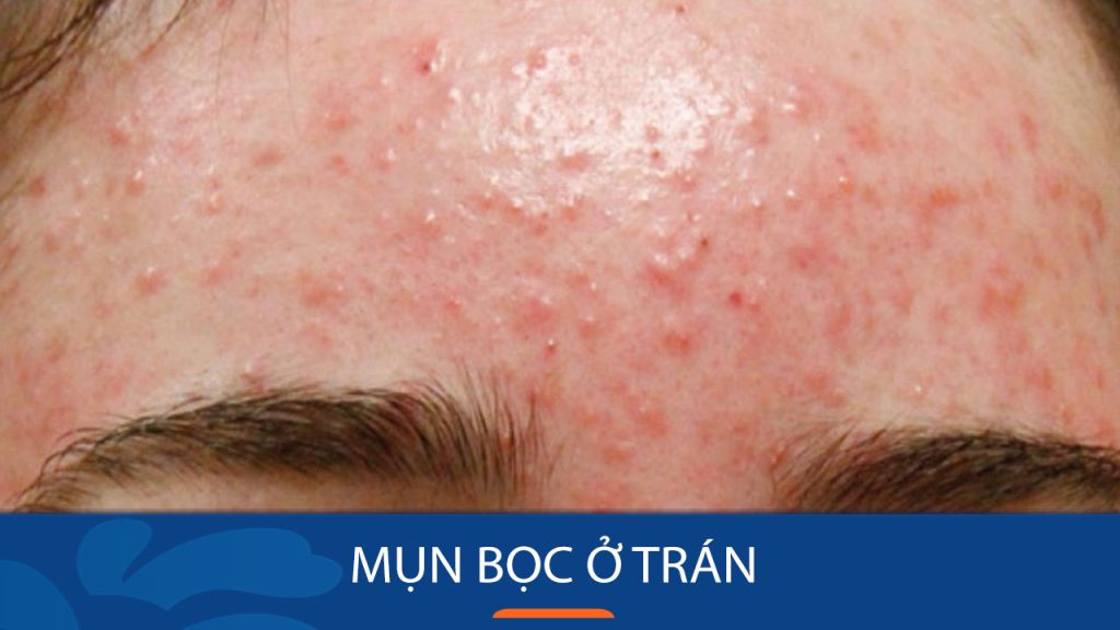 Bí quyết đánh bay mụn bọc trán tận gốc, trả lại làn da mịn màng