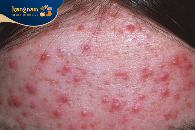 Mụn bọc ở trán