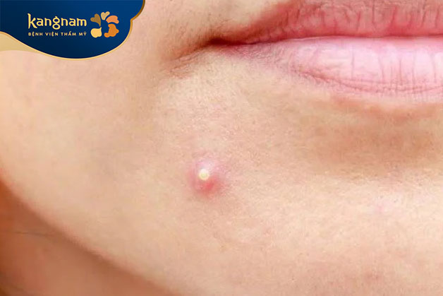 Mụn trứng cá bọc mọc ở cằm do sự gia tăng sản xuất dầu nhờn