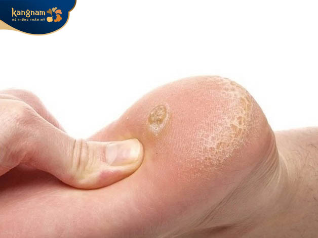 Mụn sưng lên ở vị trí phổ biến nhất là lòng bàn chân, gót chân, ngón chân,...