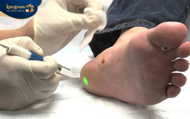 điều trị mụn cóc sử dụng ánh sáng laser để loại bỏ nốt mụn cóc trên cơ thể một cách nhanh chóng, an toàn