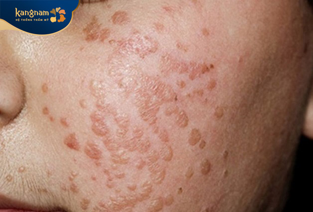 Mụn cóc phẳng là một bệnh lý truyền nhiễm ngoài da lành tính