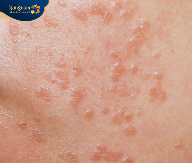 virus gây ra mụn cóc phẳng thường là HPV tuýp 3, 10, 28 và 49