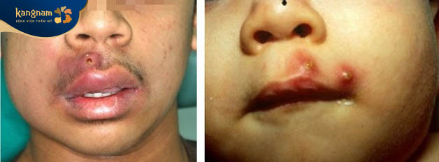 Mụn đinh râu mọc ở mặt gây đau đớn khó chịu