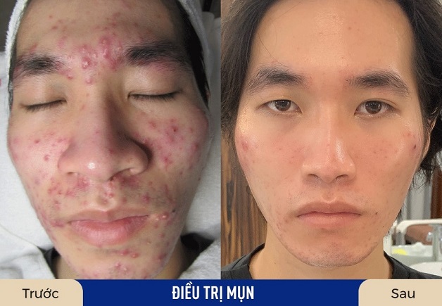 Hiệu quả trị mụn rõ rệt, da số khách hàng đều cảm thấy hài lòng