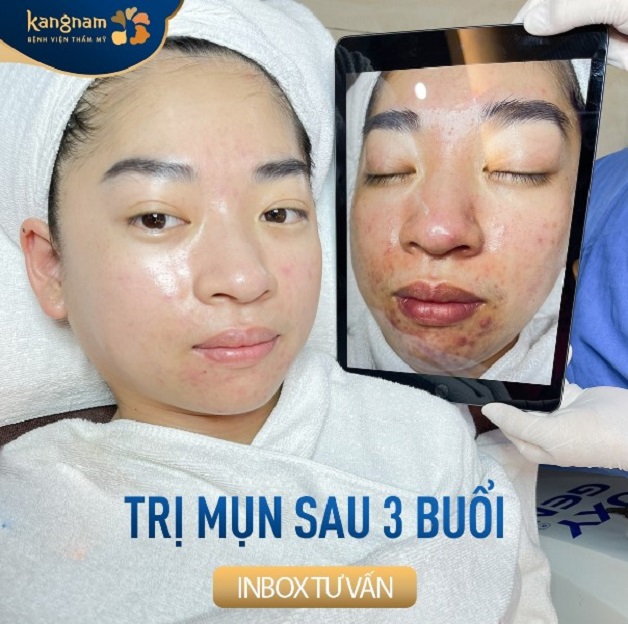 Làn da của Linh sau buổi trị mụn thứ 3