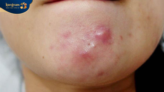 Mụn nang là những nốt mụn to, có chứa mủ