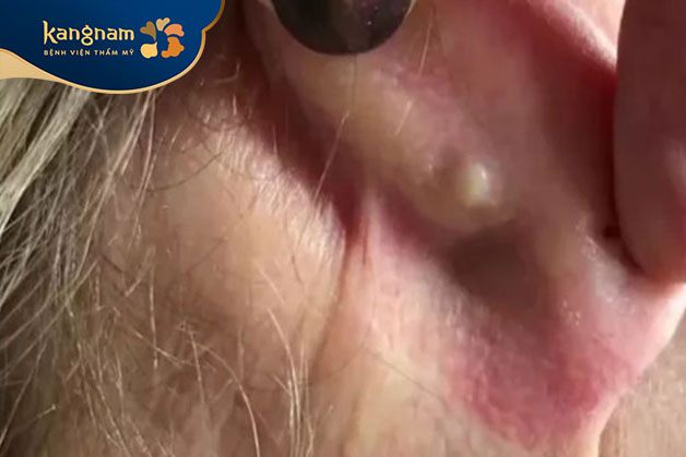 Không nên nặn mụn mọc sau tai