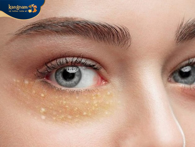 Mụn thịt ở mắt là các khối u tuyến mồ hôi li ti nhỏ như hạt gạo, mọc nhiều và lan rộng nhanh chóng