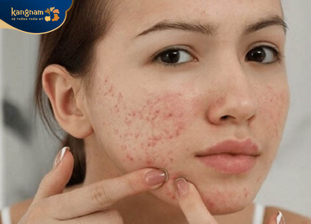 Tuổi dậy thì có khả năng bị mụn trứng cá cao nhất