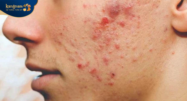 Thay đổi nội tiết tố là một trong những nguyên nhân chính gây mụn