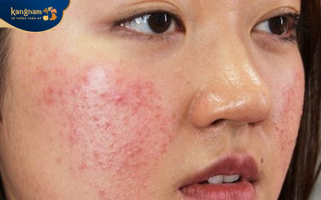 Vùng da hai bên má sần sùi, có nhiều dầu, lỗ chân lông to