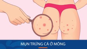Mụn trứng cá ở mông: Bí quyết đánh bay mụn trứng cá ở mông chỉ trong 7 ngày