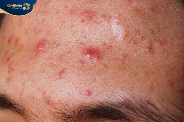 Mụn trứng cá mọc ở trán gây ra nhiều tác hại