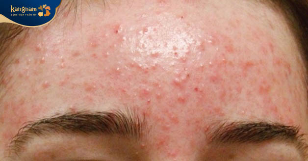 Mụn trứng cá ở trán do nhiều nguyên nhân gây nên
